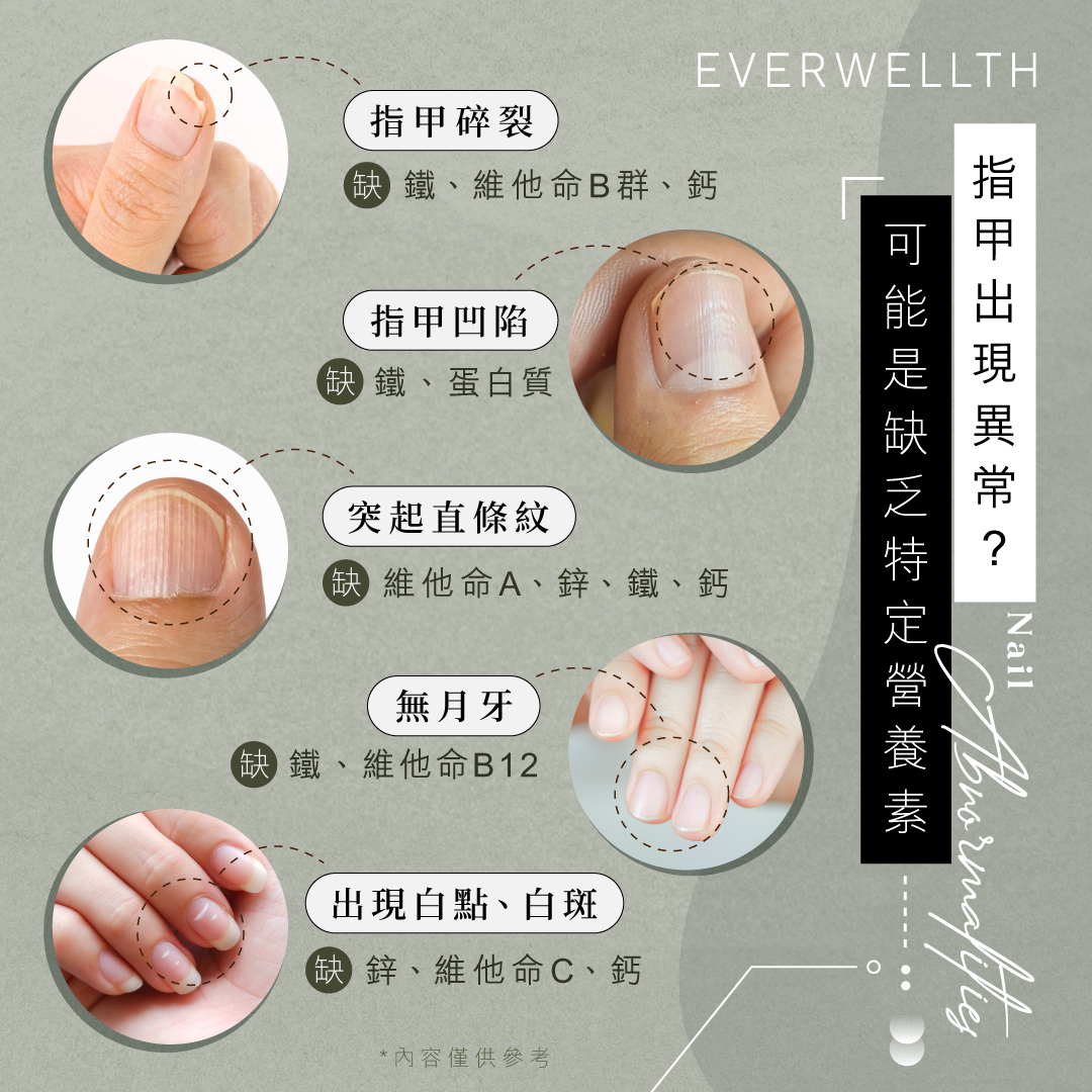 健康知識｜指甲症狀顯示身體缺什麼！凹陷、斷裂、線紋問題一次看 - Medical/Infographics /Infographics ...