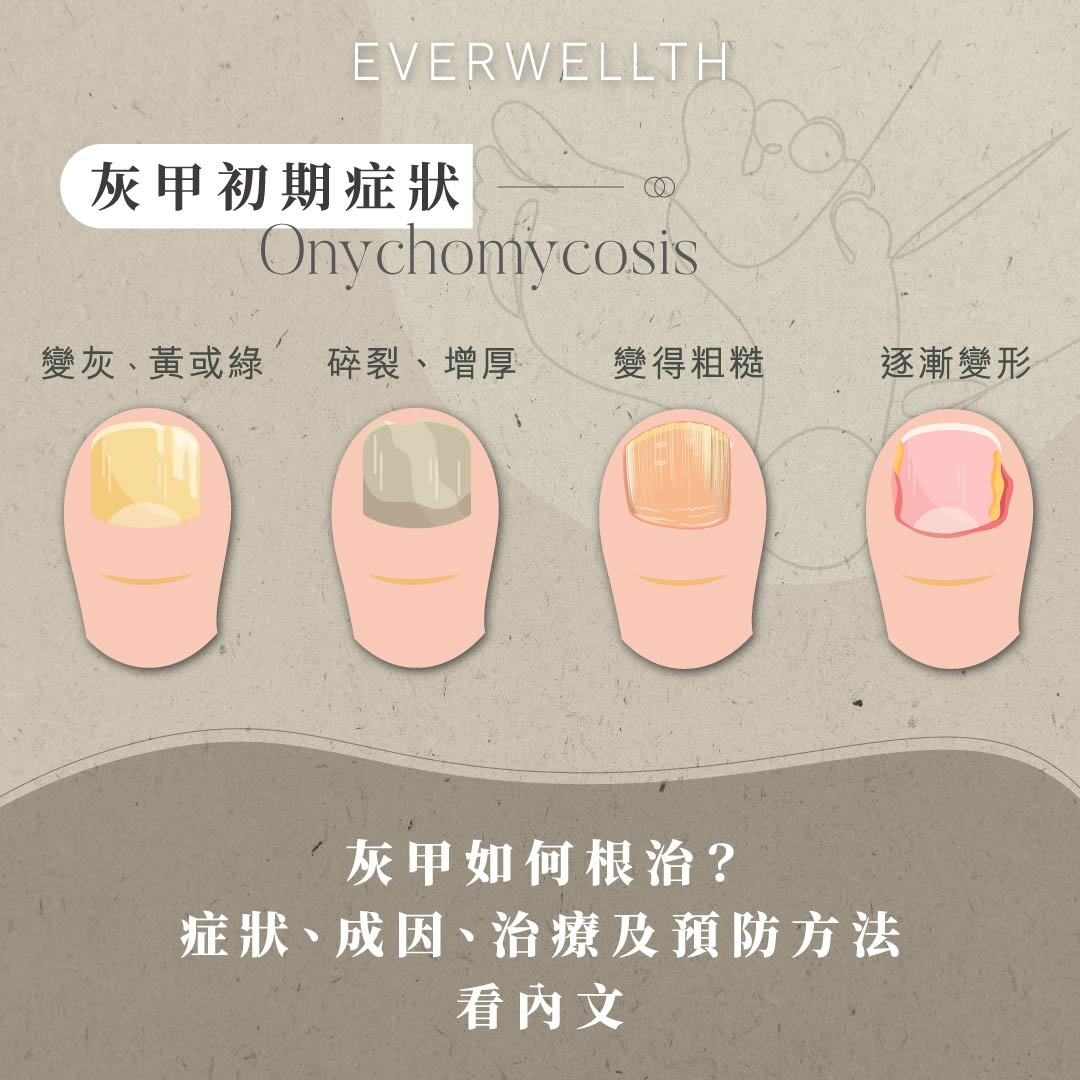灰甲|灰甲初期有何症狀?如何根治?一文看清灰甲症狀、成因、治療及預防方法! - Medical - 2023-11-11| Everwellth